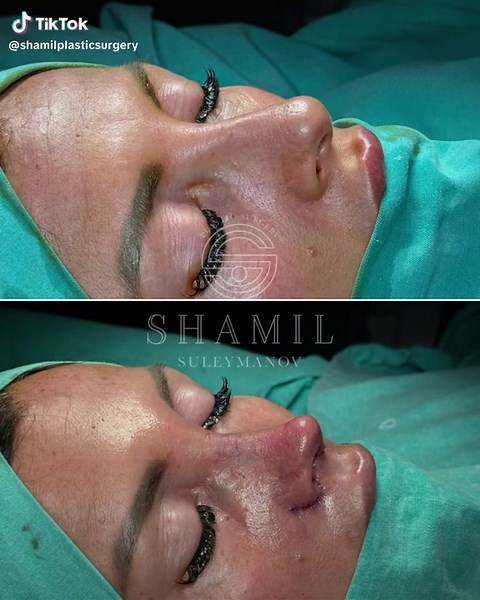 Rhinoplasty, commonly known as a nose job, is a surgical procedure aimed at reshaping the nose for aesthetic or functional purposes. It can address issues like size, shape, symmetry, and breathing difficulties. Results vary depending on individual anatomy and goals. Consultation with a qualified surgeon is essential for personalized advice #rinoplastia #rhinoplasty #rinoplastika #rinoplasti #nosejob #rinoplastikabaku #ринопластика #plasticsurgery