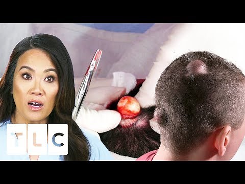 Dr. Lee Gets Sprayed By Explosive Cyst On Man's Head | Dr. Pimple Popper