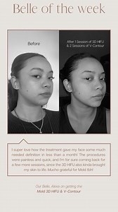 20 reactions | Suck away sagging skin with Mold Manila's 3D HIFU. 3D...