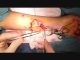 Excision of a Schwannoma Tumor • Video • MEDtube.net