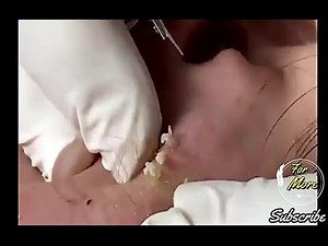 Dr Pop - Acne, Whiteheads & blackheads Removed 2020 (UHD)