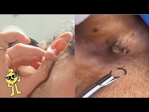 Ultimate Compilation: Big Cystic Acne, Blackheads & Whiteheads Removal | Satisfying Pimple Popping