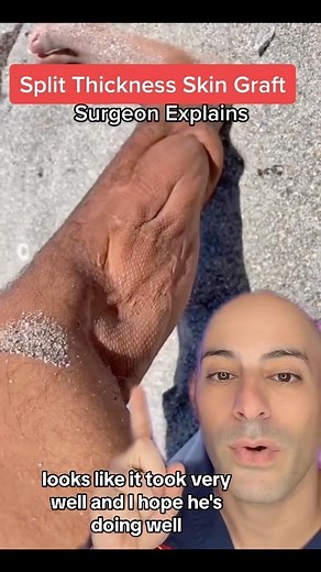 23K views · 26 reactions | Here’s how a skin graft works in medicine! When there is skin or soft tissue loss - we Rob from Peter (thigh) to pay Paul (defect area). ✅Follow @drdavidabbasi for More Daily Medical Content & Health Tips! #skingraft #plasticsurgery #traumasurgery #generalsurgery #medicine #nursing #orthopedics #drabbasi | David Abbasi, MD - Sports Medicine & Orthopedic Surgery | Facebook