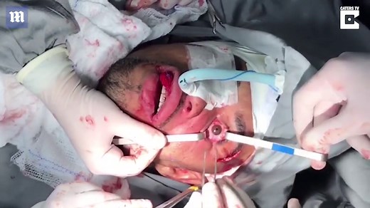 Gruesome eyeball surgical procedure tests patient's eye movements