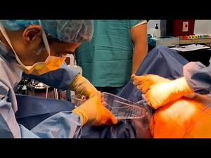 Breast Augmentation W/ The Largest Implants They Make | 800cc Implants | Full Surgery | Seattle