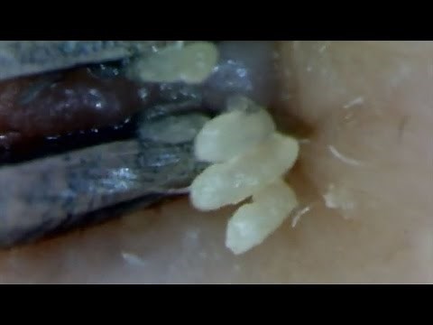 #09 Continuous Removal of Blackheads Close up - Squeezing Blackheads