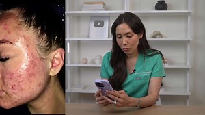 Viral acne hacks effectiveness dermatologist with sixteen plus years explains