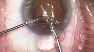IOL Exchange with Advanced Haptic Stripping - Eyetube