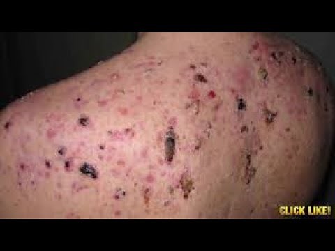 Biggest blackhead removal | Compilation
