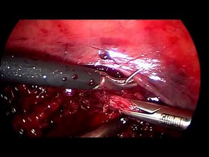 Histerectomia por laparoscopia