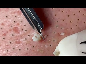 Huong Da Nang Acne Treatment (#378) #Huongdanang