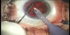 RLE and alcon restor IOL implantation