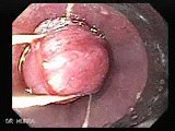 Hemorrhage After Ligation - Procedure of Banding • Video • MEDtube.net