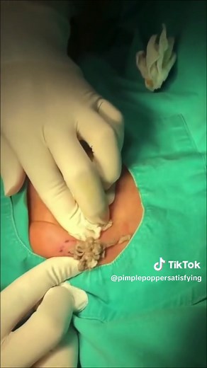 Cyst explosion #pimple #blackheads #pimplepoppersatisfying #blackhead #fyp