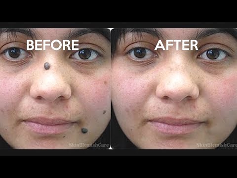 2 Easy Ways To Remove Moles From Your Face | How To Get Rid Of Moles