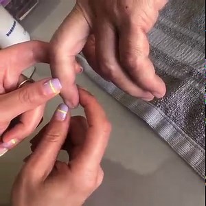 Signo de Hoffman y signo de Trommer positivos: estos reflejos patológicos se producen cuando hay una lesión en la vía piramidal, que es la que se encarga de los movimientos voluntarios del cuerpo. En este caso el paciente tiene secuelas de un ECV isquémico. | FisioCare Clínica de Fisioterapia y Rehabilitación