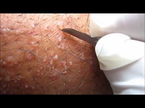 Popping Pustular Rash