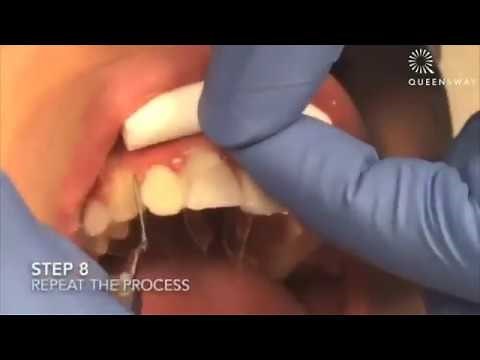 Composite Veneers - See how it's done at Queensway Dental!