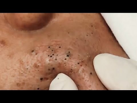 Satisfying Blackhead Removal