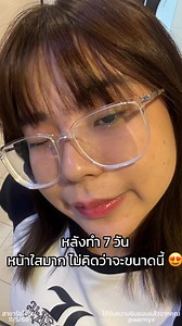 1.1K views | โปร กำจัดรอยดำ✨  PROGRAM Q-Switch: บอกลารอยดำกวนใจ เคลียร์ผิวเนียนใส  2 ครั้ง เพียง 899.- คุ้มมาก จองเล้ยยย❤️ | W Clinic อุบลราชธานี | Facebook