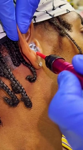 #pimple #blackheads #squeezie #pimplepop