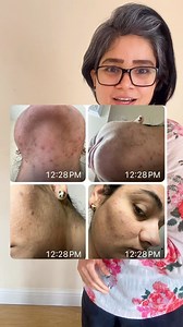 Tired of facial removal let’s talk #facialtreatment #pcos | poonam.joshi777