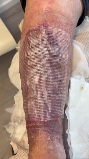 Stauungsdermatitis richtig behandeln: Diprogenta, Exsudatmanagement, Kompression
