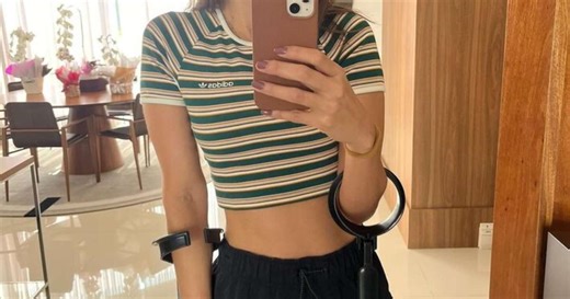 Vera Viel mostra evolução de tratamento após cirurgia para retirada de tumor raro na perna; veja