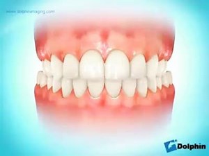 3.4K views · 101 reactions | Posterior crossbite correction with elastics. | Dr.Sreenath S | Facebook