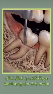 #fypage #explorer #dental_tips #dental #composite | Dental bites