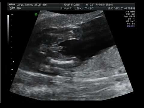 18 week ultrasound scan obvious boy gender reveal