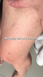 Gaslighted by the doctors. Do you say that? I’ve been told all of this, so I know. Eventually found out I have pelvic venous disorders and got treated with coil embolization and EVLA. Life changing for me❤️ no pain! #pelvicvenousdisorders #pelviccongestionsyndrom #varicoseveins #pelvicpain #chronicpelvicpain