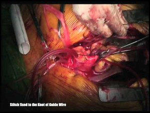 Elephant Trunk in Aortic Dissection Surgery with Guide Wire • Video • MEDtube.net