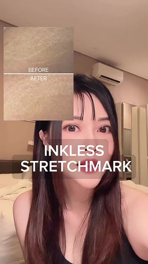 Inkless Stretchmark Removal Techniques Explained