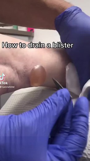 #blister #blisterpopping #blisterpoppin #hugeblister #blisterpop #whattodo #skinfacts #skindoctor
