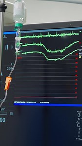 Astăzi vă arătăm ce se întâmplă în timpul unei intervenții de coronarografie. Pacientul rămâne conștient, iar medicul îi vorbește pe tot parcursul procedurii. Fiecare explicație, intrebare și răspuns contează, pentru ca pacientul să se simtă în siguranță, înțeles și în grija unei echipe care îl ascultă. ___ Centru de Cardiologie Intervențională Bethesda 0330 401 801 Str. Nicolae Labiș, nr. 33, Suceava #bethesdacci #suceava #cardiologieinterventionala #cardiologie #coronarografie | Bethesda CCI