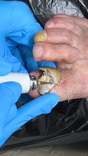 12K views · 76 reactions | The treatment for onychogryphosis! | Alena Lavrenteva | Facebook