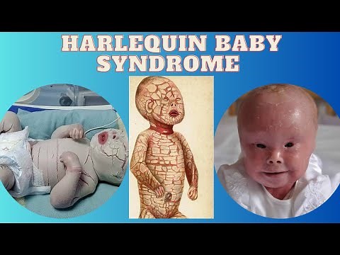 Harlequin Baby Syndrome | Shocking genetic disease #genetics #health