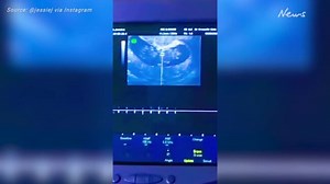 Jessie J reveals she’s pregnant after miscarriage heartache