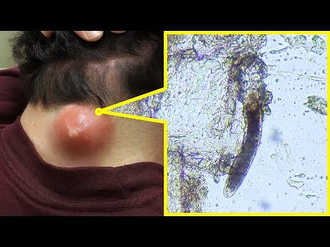 Microscopic Look at Acne: You Won’t Believe What’s Hiding in Your Skin | TULO - Microscope