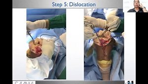 Dealing with Severe Varus Deformity in Total Knee Arthroplasty