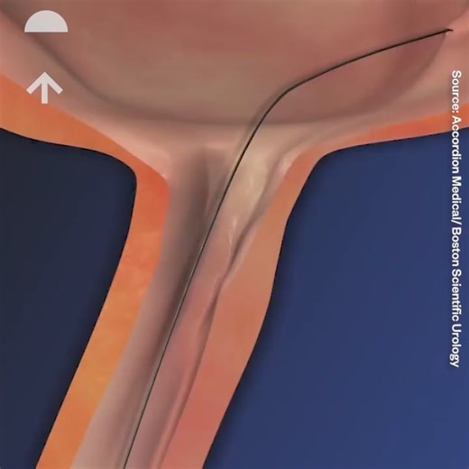 This is how doctors remove kidney stones 😮 | Science Room