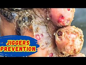 The Simple Prevention Method That Could End Jigger Infestations | Jigger Prevention