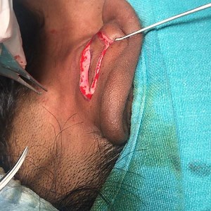 4.1K views · 21 reactions | Protruding ear correction: Skin Excision...