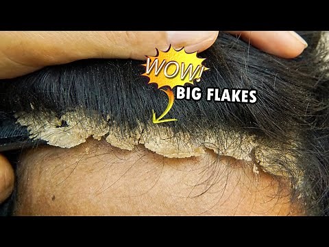 Huge Dandruff Flakes Removal #457