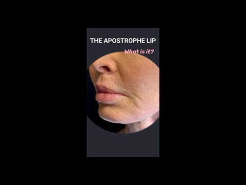 Medialized Corner Lip Lift - To Treat Apostrophe Lips