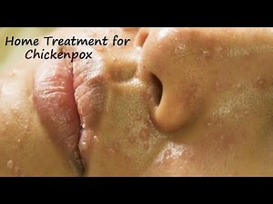 Home Remedies for ChickenPox I ChickenPox Treatment I Treatment for Chickenpox I To Cure Chicken pox