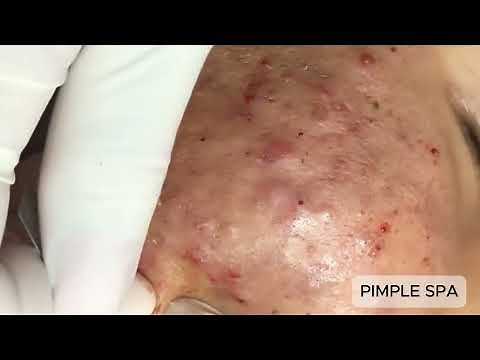 Satisfying Face Pimple Popping in Real Time - Massive Acne Removal Compilation Part 1