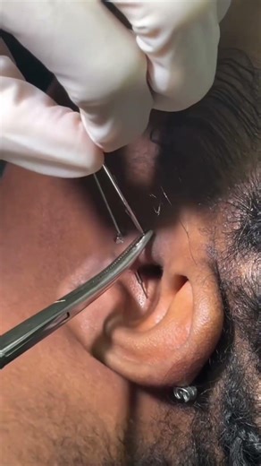 How to Fix a Double Tragus Piercing | Bump Treatment + Aftercare Routine 💧