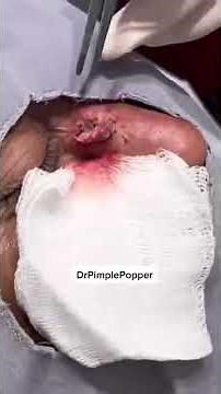 🌋 A Volcanic Removal From a Nose! #shorts #drpimplepopper #pimplepopping